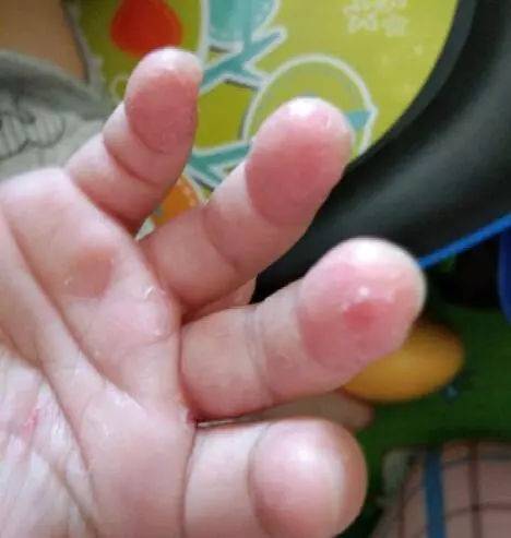 小孩手指脱皮不单是缺维生素，还有哪些原因？家长别忽略了