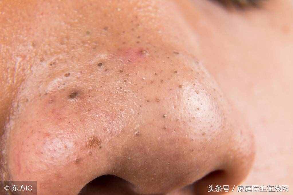 脸上黑头太多怎么办？这3个正确方法帮助你消灭它们