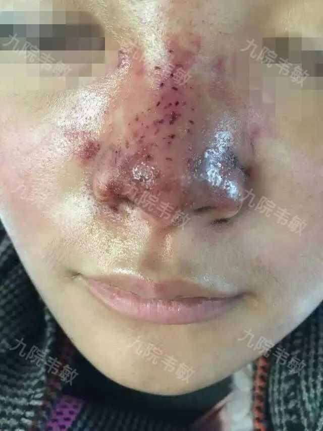 鼻整形为什么不建议注射隆鼻？