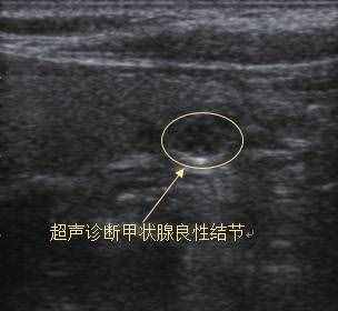 七个问答，全面了解甲状腺结节