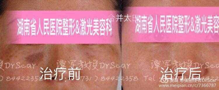 褐青色痣（颧骨母斑）的激光治疗