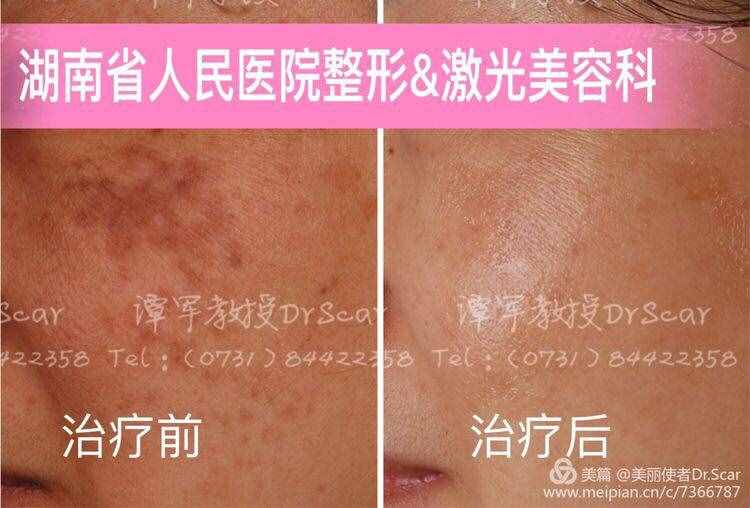 褐青色痣（颧骨母斑）的激光治疗