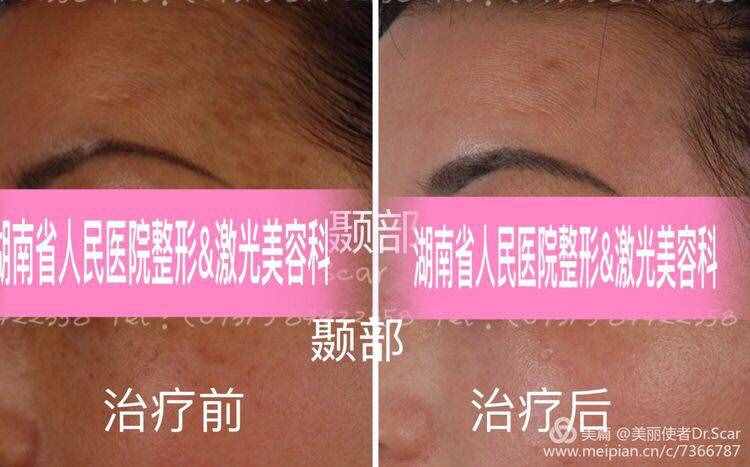 褐青色痣（颧骨母斑）的激光治疗