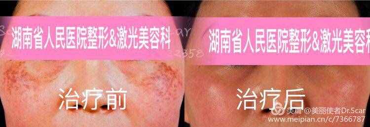 褐青色痣（颧骨母斑）的激光治疗