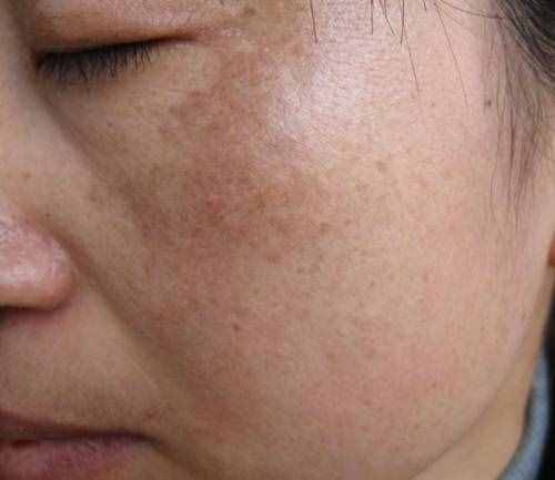 脸上有很多斑怎么淡斑？四种小妙招