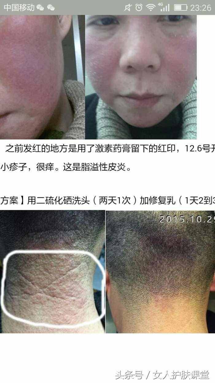 脂溢性皮炎怎么治疗？