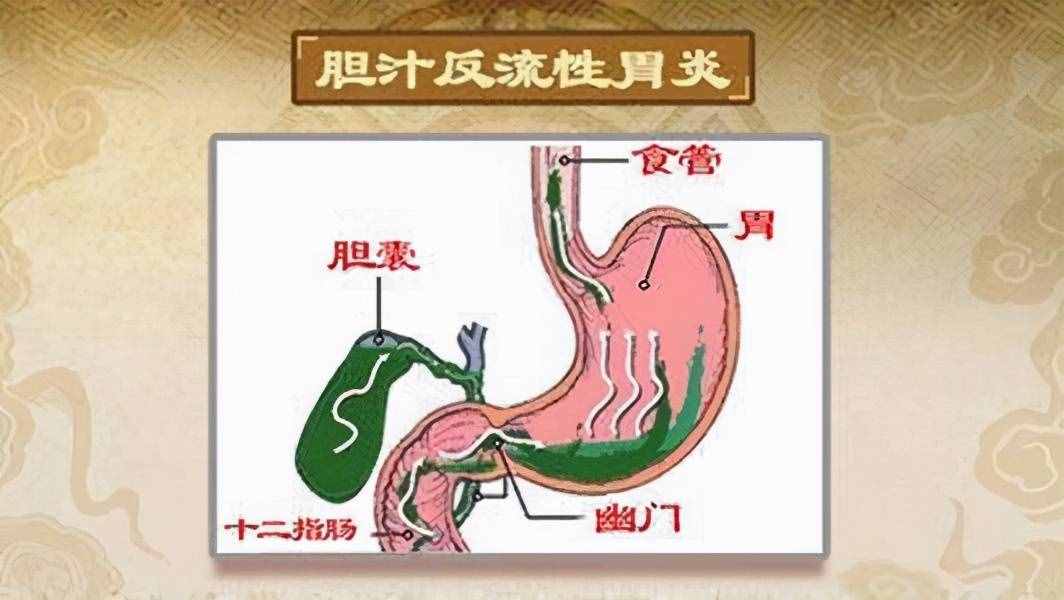 胆汁反流性胃炎怎么治疗？医生推荐4种常用的治疗药物