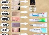 今日更新痘痘如何处理(去除痘印用什么药膏)