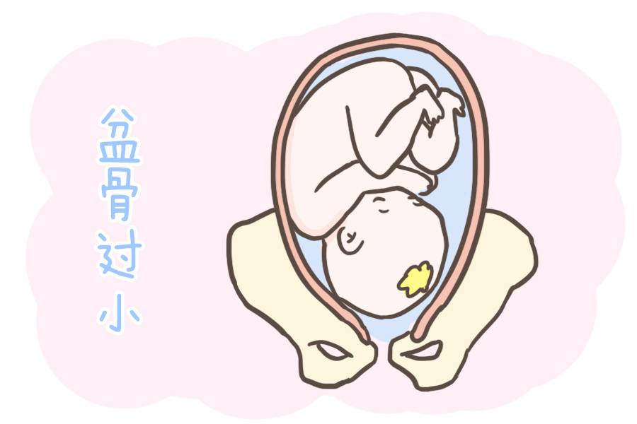 准妈妈第一胎如果是剖腹产,那么第二胎该怎么生?看完这篇就懂了