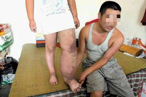 KT综合征是什么意思？有哪些症状和危害？