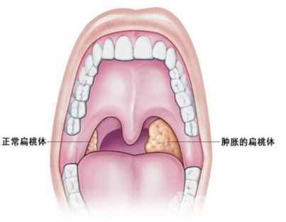 孩子扁桃体发炎怎么办？到底要不要切？