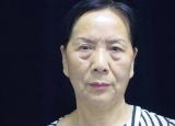 今日更新怎么样去眼袋效果好（最显老的不是皱纹）