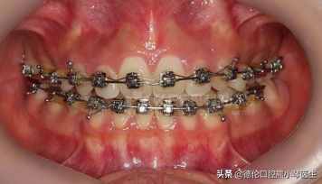 龅牙的矫正方法有哪些？