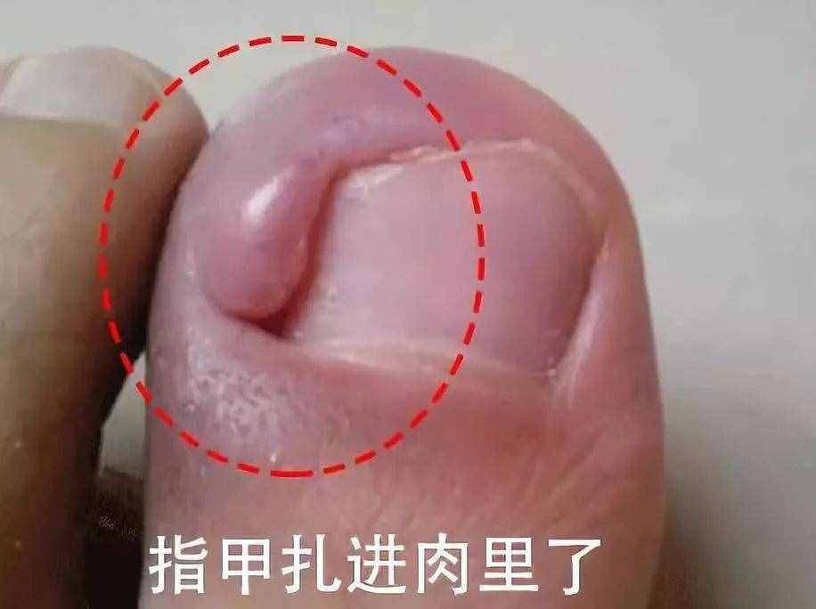 为啥脚趾甲动不动就长到肉里，还疼得受不了？在家怎么解决？