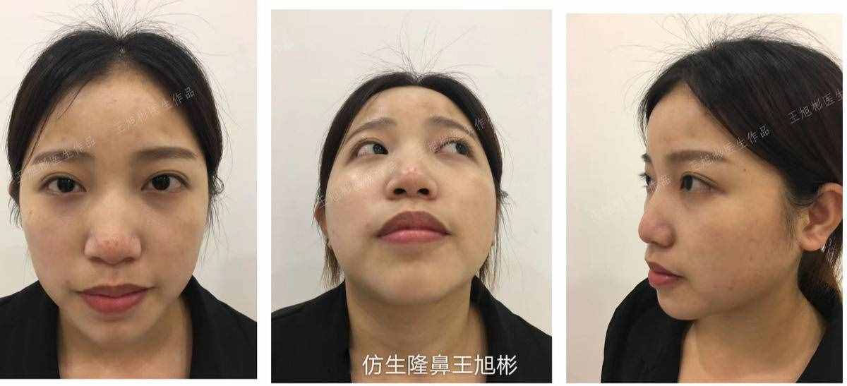 鼻头肥塌大，如何逆袭成自然小秀挺？王旭彬仿生鼻尖整形案例