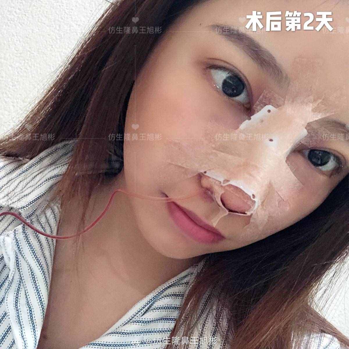 鼻头肥塌大，如何逆袭成自然小秀挺？王旭彬仿生鼻尖整形案例