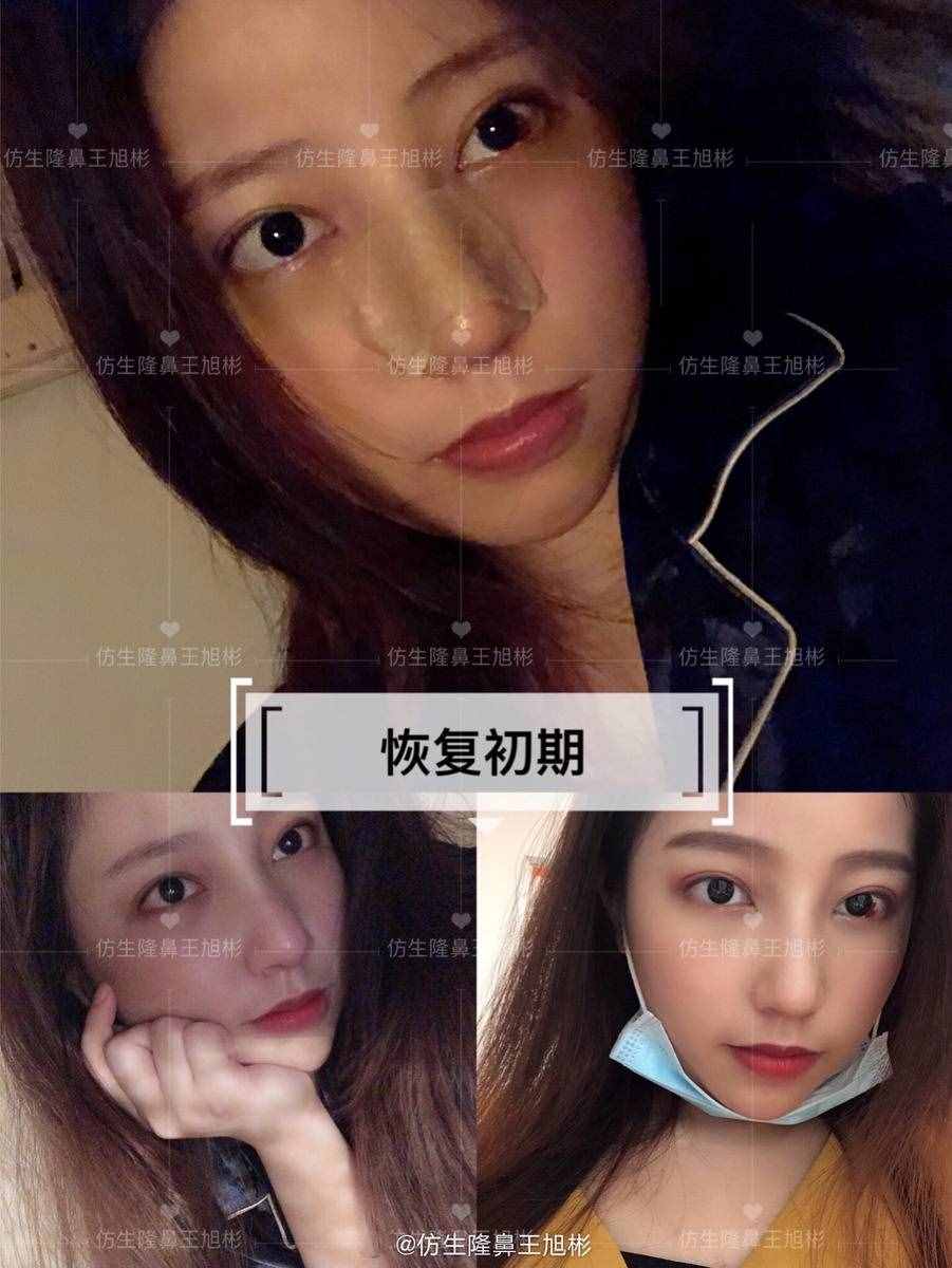 鼻头肥塌大，如何逆袭成自然小秀挺？王旭彬仿生鼻尖整形案例