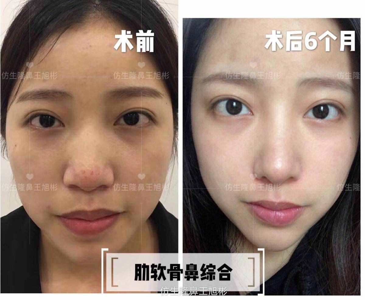鼻头肥塌大，如何逆袭成自然小秀挺？王旭彬仿生鼻尖整形案例