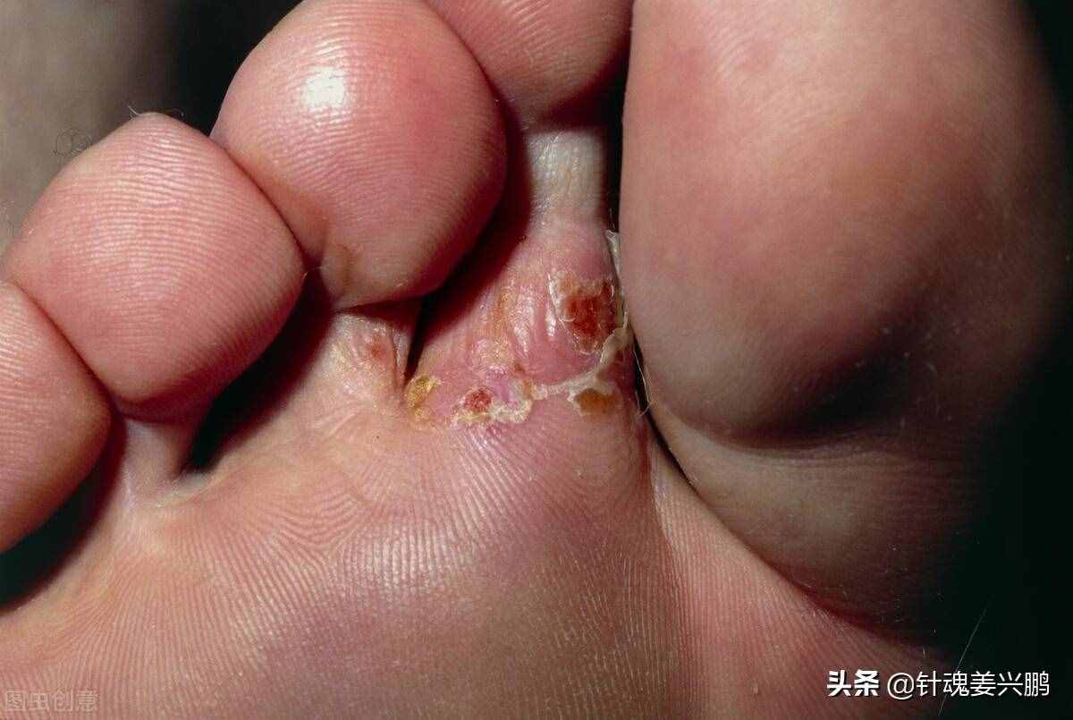 “脚气”真菌怎么才能根治？3个人人实用的方法，彻底治好不复发