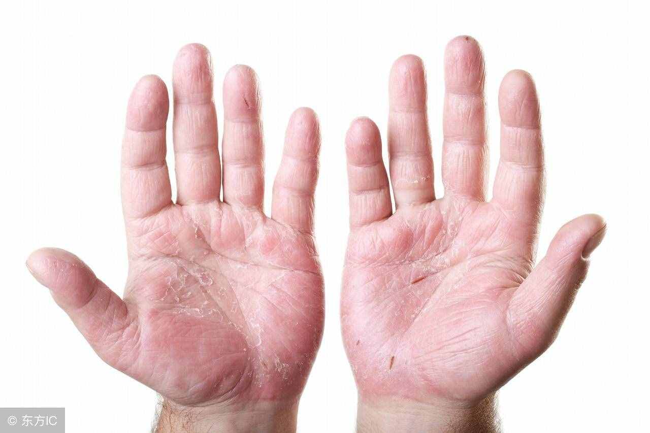 湿疹最典型的症状特点与分类