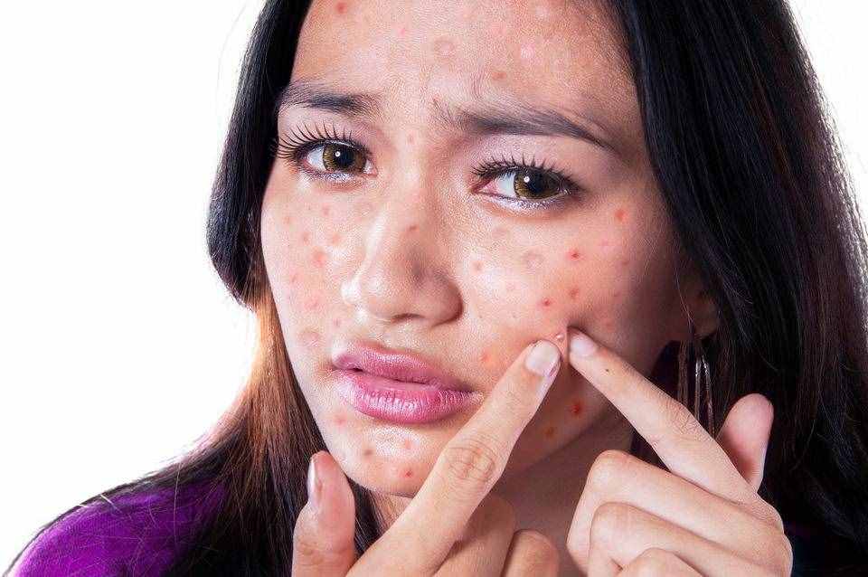 医生治痤疮常用3种方式，日常做好这2件事，也能拯救你的"痤疮脸"