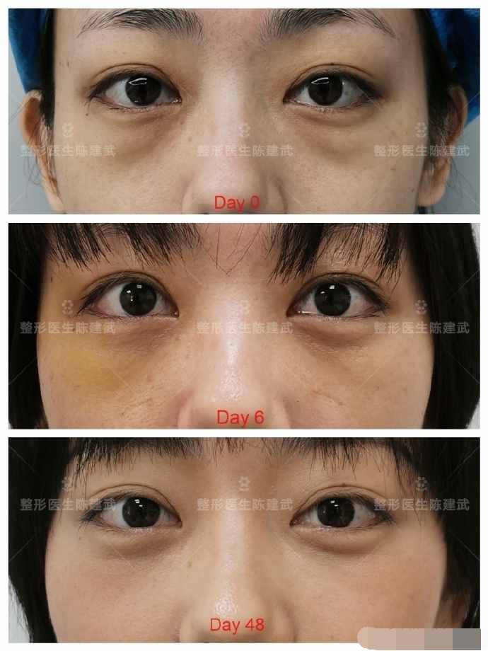 31岁美女内切眼袋失败，我帮她修复改善，重启美丽人生