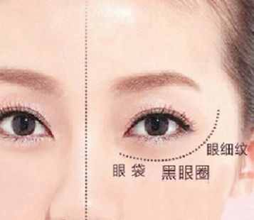 31岁美女内切眼袋失败，我帮她修复改善，重启美丽人生