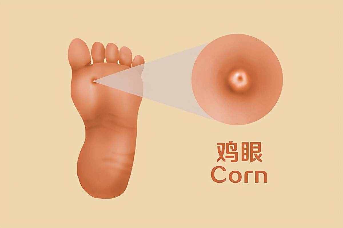 脚上长了鸡眼，有什么好方法能去除？鸡眼的原因有哪些？