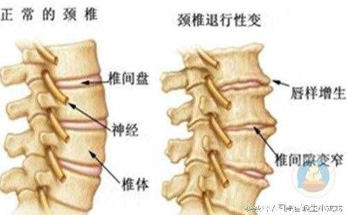 骨质增生秘方大公开，告别疼痛，治一个好一个的良方！
