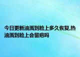 今日更新油溅到脸上多久恢复,热油溅到脸上会留疤吗