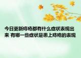 今日更新痔疮都有什么症状表现出来 有哪一些症状是患上痔疮的表现