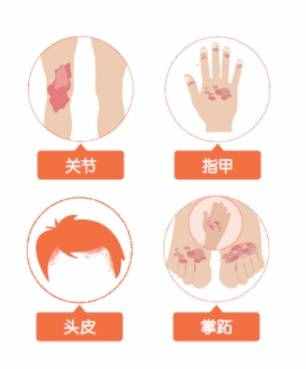 叫癣不是“癣”，细数牛皮癣的那些事