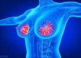 今日更新乳腺增生怎么办(乳腺增生自己如何调理)