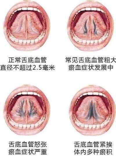 神奇的中医放血疗法