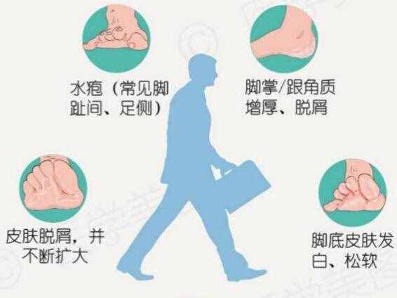 夏季是“香港脚”频发季，医生：家庭用醋泡脚达不到杀菌效果，30%的医用冰醋酸才有效