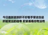 今日最新更新肝不好看手掌这些是肝脏发出的信号 赶紧看看你有没有