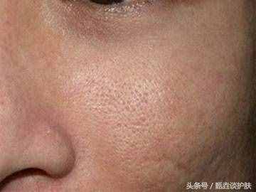 “毛孔粗大”的真正原因，您可能想不到？
