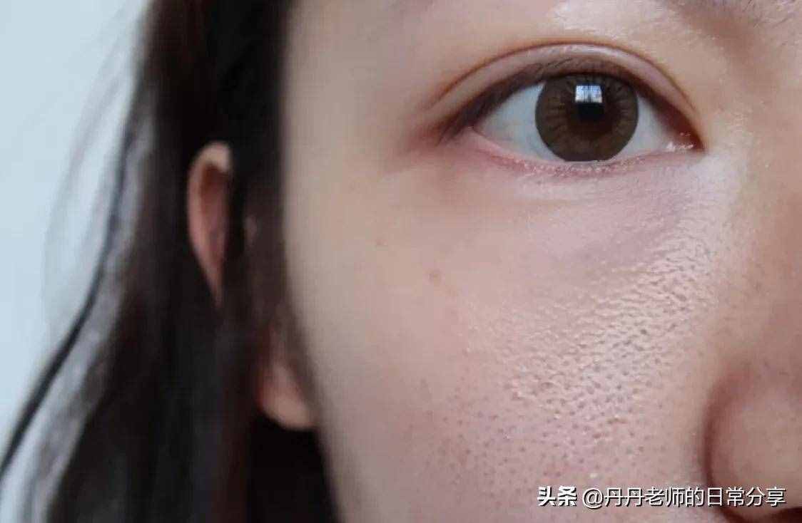 面部毛孔粗大怎么办，怎么收缩毛孔？