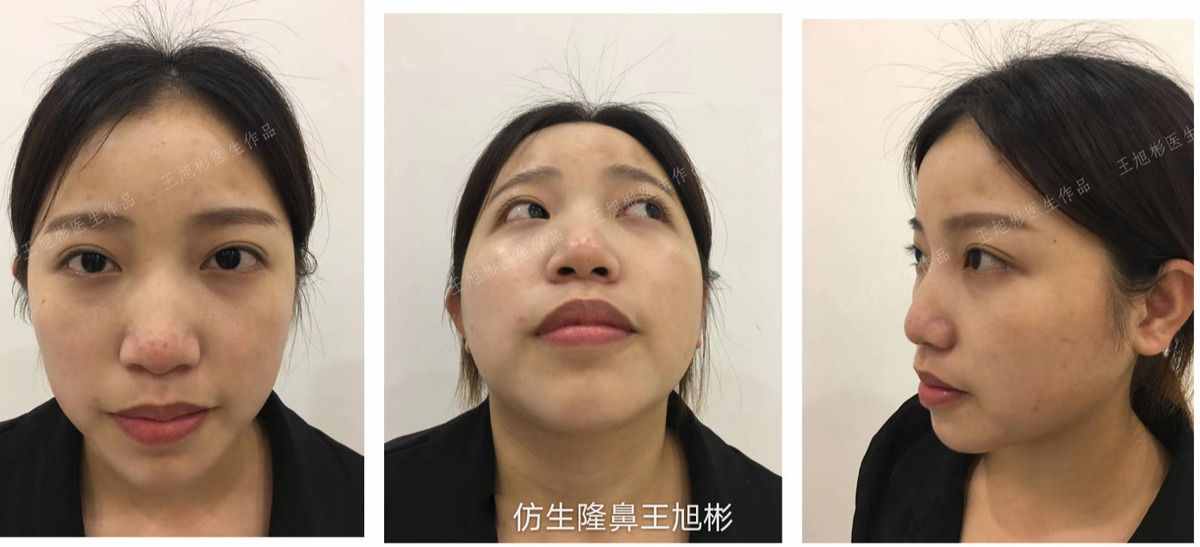鼻头肥塌大，如何逆袭成自然小秀挺？王旭彬仿生鼻尖整形案例