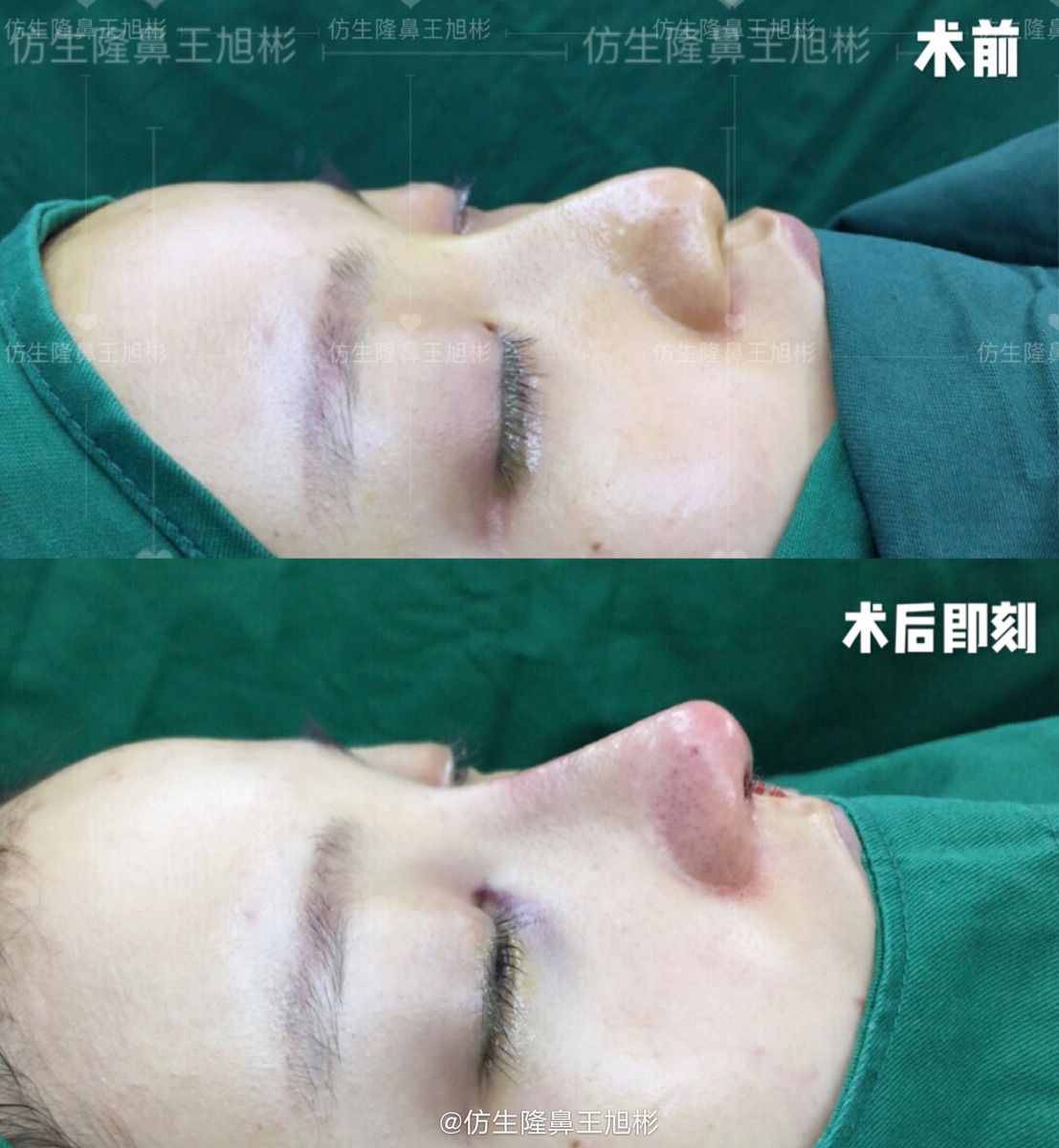 鼻头肥塌大，如何逆袭成自然小秀挺？王旭彬仿生鼻尖整形案例