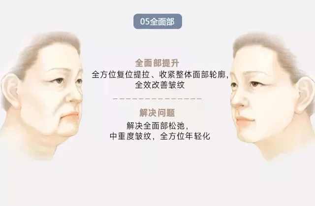 面部年轻化可以改善哪些方面？