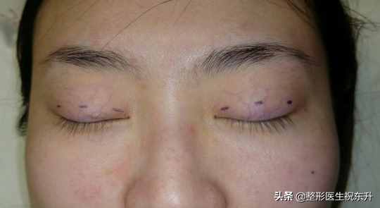 什么是三点式双眼皮？有什么特点？