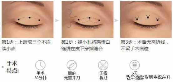 什么是三点式双眼皮？有什么特点？