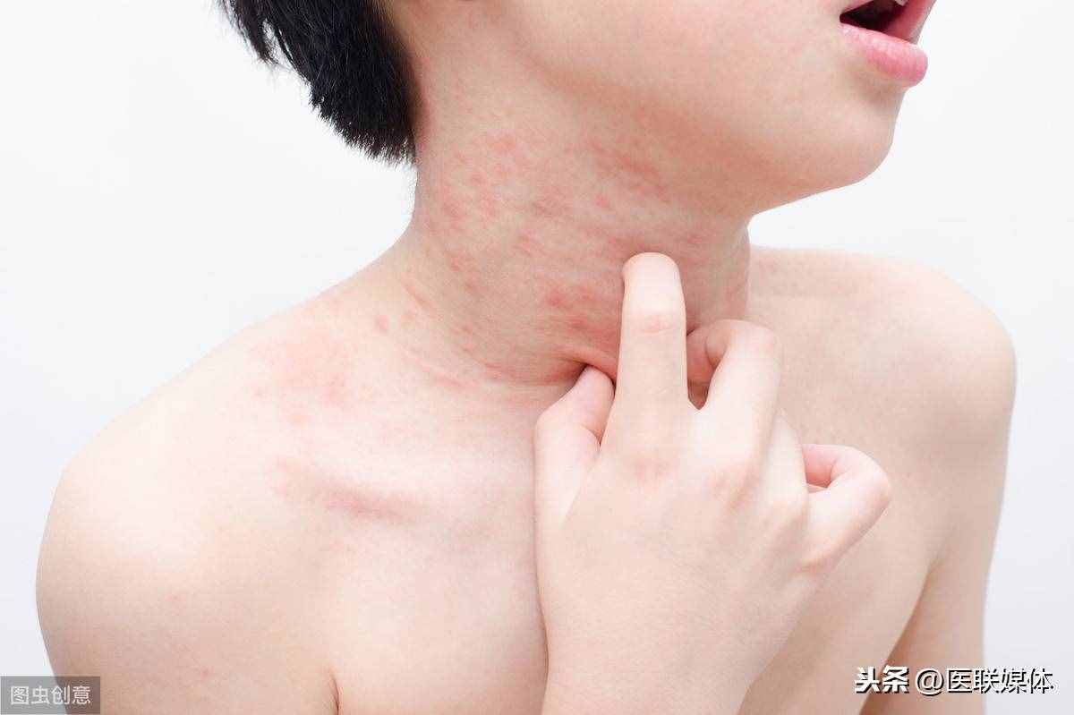 皮肤过敏会出现哪些症状？医生：多有这一表现，得学会辨别