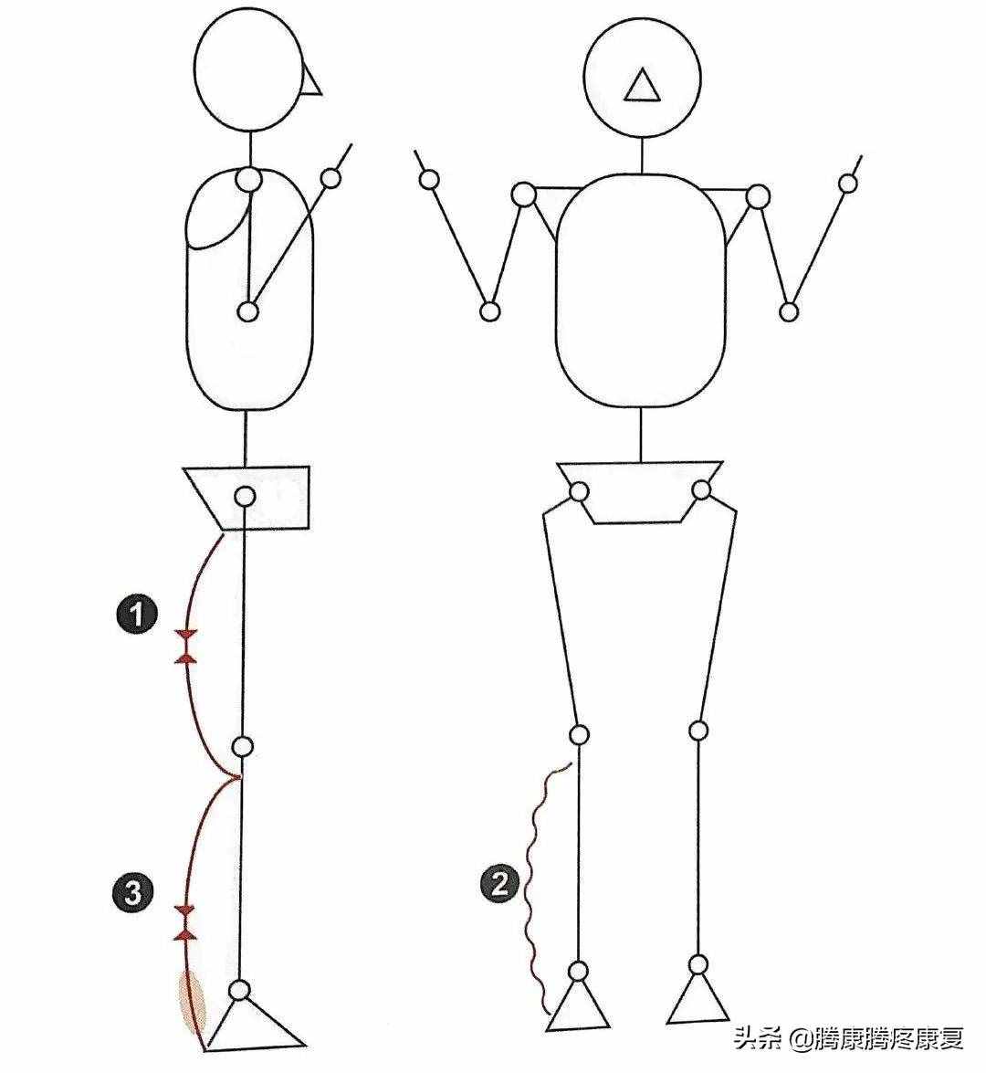 跟腱炎的分析与诊疗