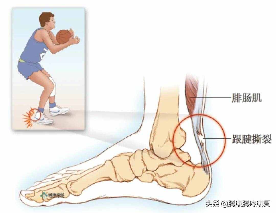 跟腱炎的分析与诊疗