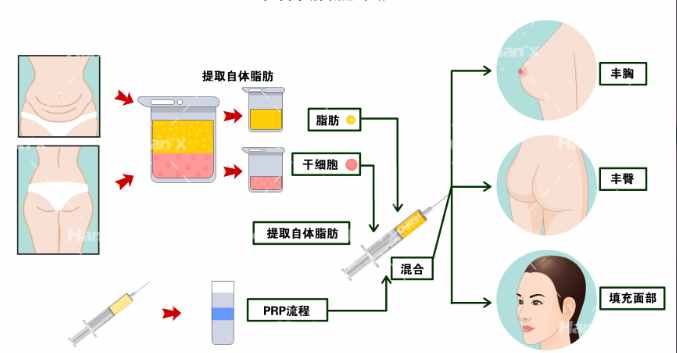 芒果吸脂手术的安全性怎么样？