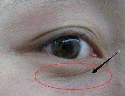 迪丽热巴都消不掉的眼纹，你想靠眼霜和按摩就消掉？