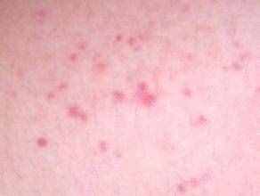 刚感染艾滋病毒（HIV）有哪些症状？潜伏期有多长时间
