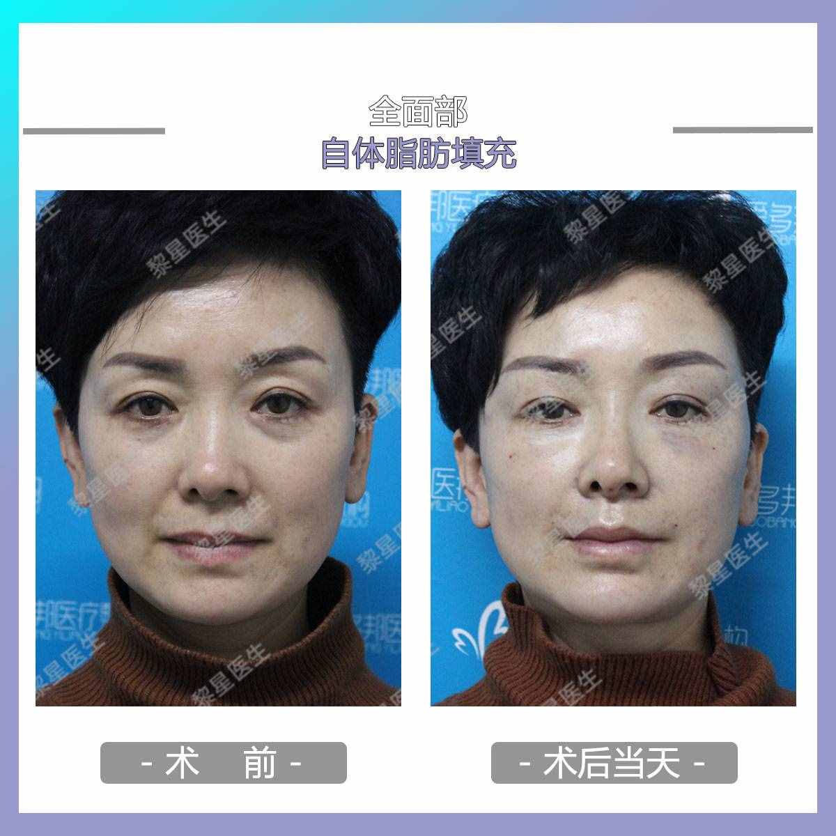 面部凹陷，皮肤松弛，像颗缺水的葡萄干，怎么办？